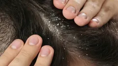 Šampón nie je potrebný: rozlúčte sa s lupinami vďaka koreniu, ktoré má doma každý